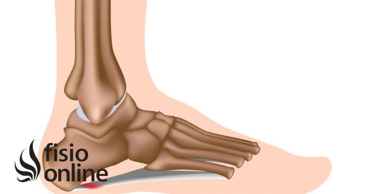 Posibles causas del dolor en los talones